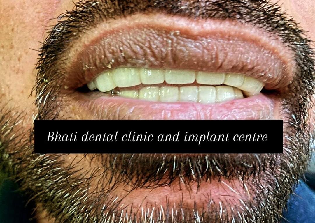 After smile design treatment at Bhati Dental Clinic